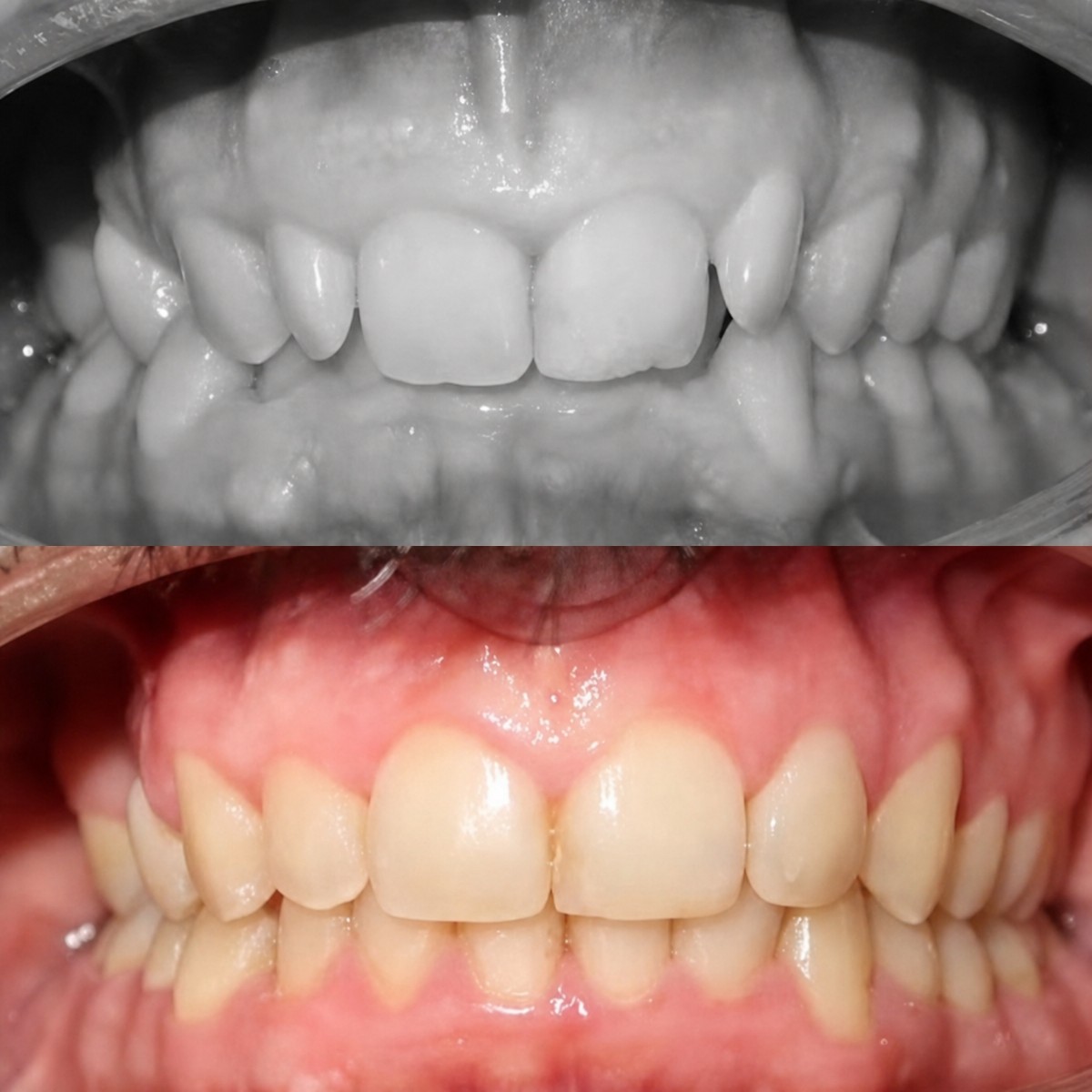 Resultados antes y después de brackets en Esthetic Smile Academy, alineación dental mejorada