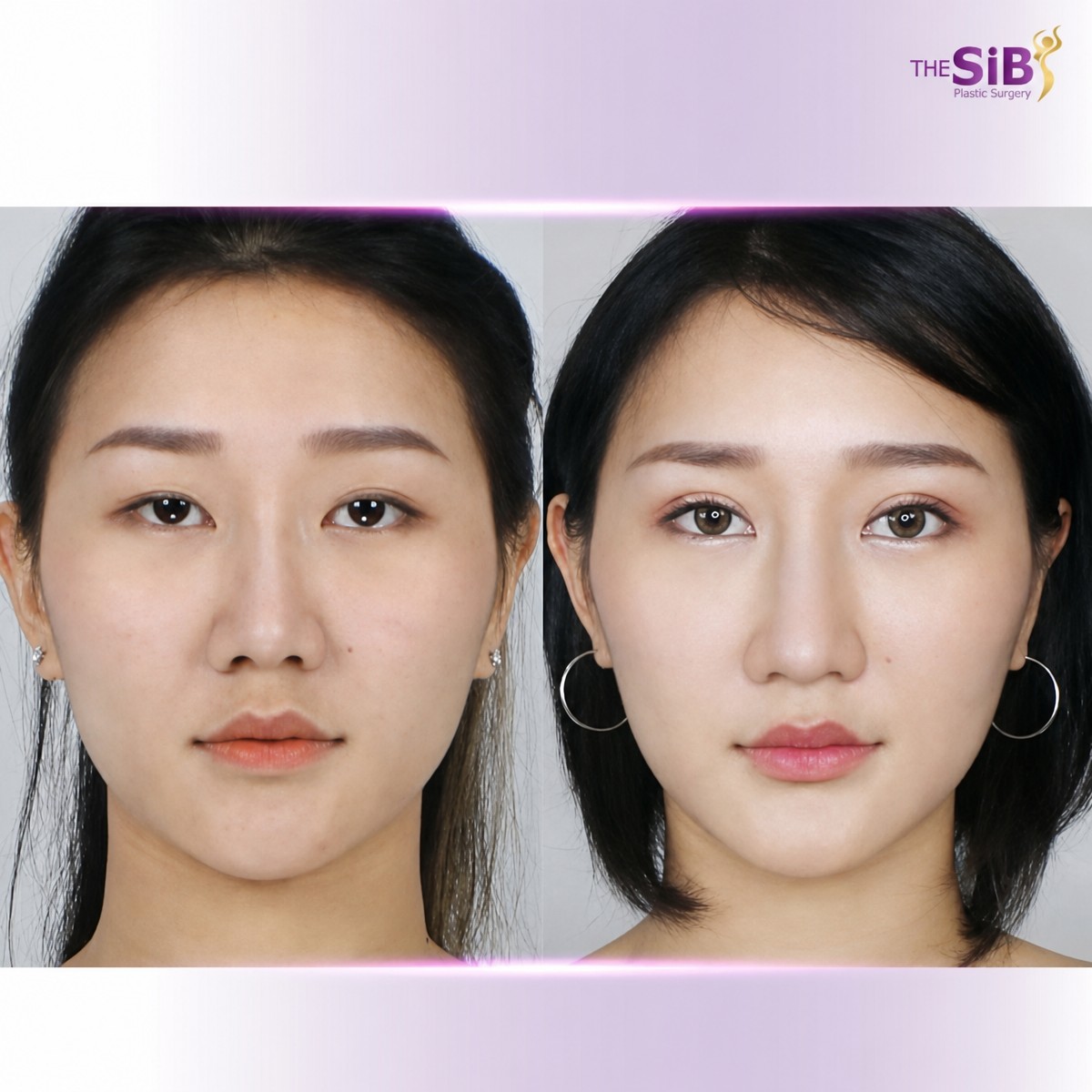 Resultados antes y después de cirugía de párpado doble en The SiB Plastic Surgery