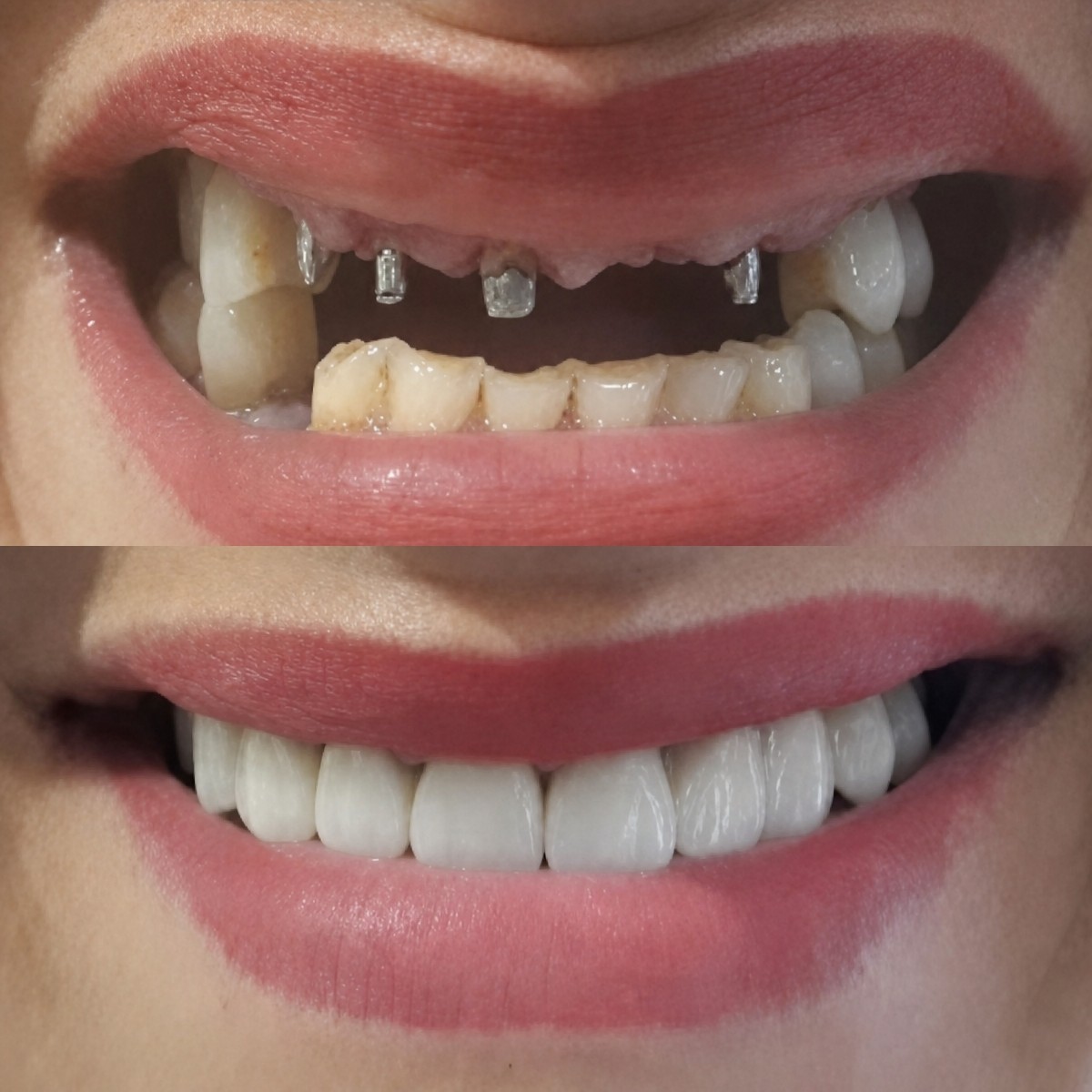 Before and after dental implant results at Hospitadent Dental Group - İstanbul Bakırköy Clinic
