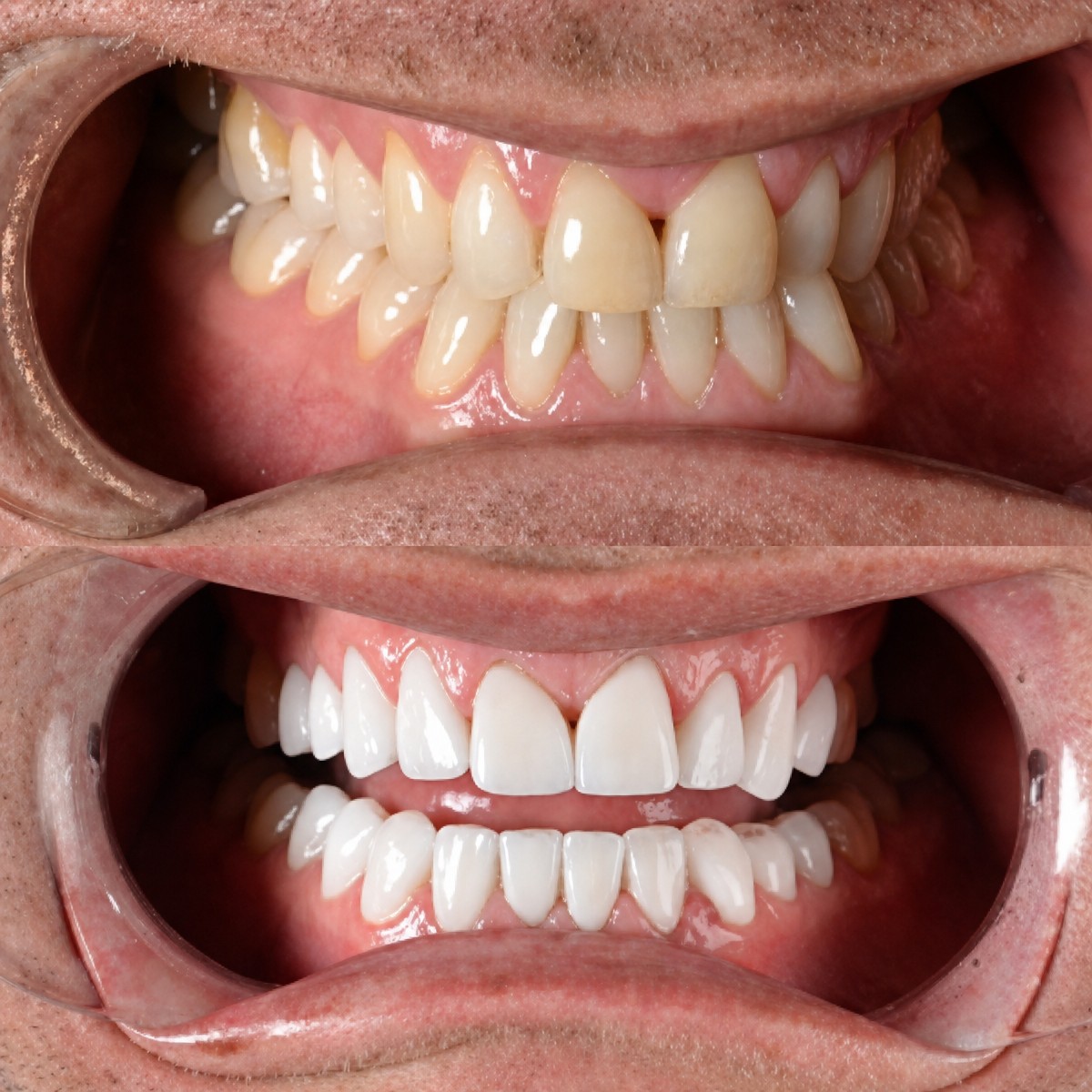 Résultats avant et après la pose de couronnes dentaires à Hospitadent Dental Group - İstanbul Bakırköy Clinic
