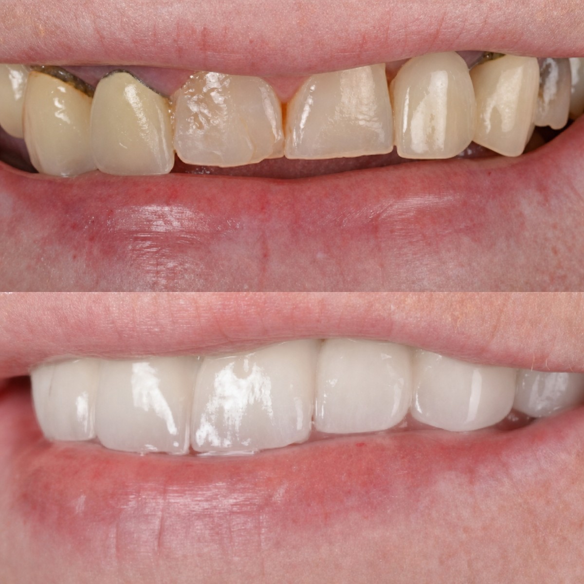 نتائج قبل وبعد تركيب تيجان الأسنان في Hospitadent Dental Group - İstanbul Bakırköy Clinic