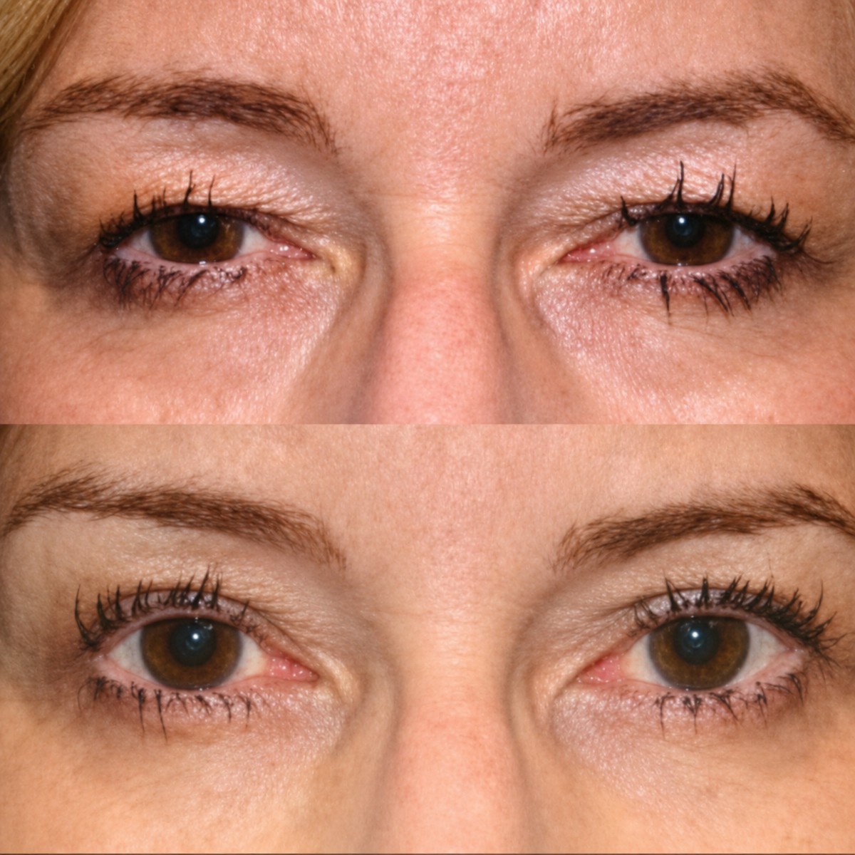 Resultados de blefaroplastia de párpado inferior antes y después en Memorial Bahçelievler