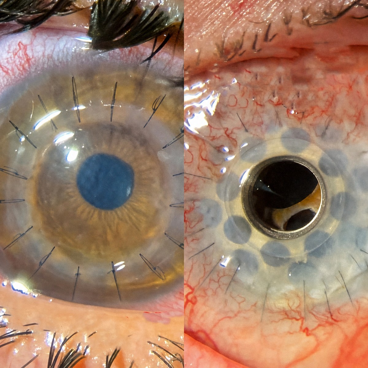 Resultados antes y después de queratoplastia en Associate Professor M. Derda Ozer DERDA SAGLIK HIZMETLERI