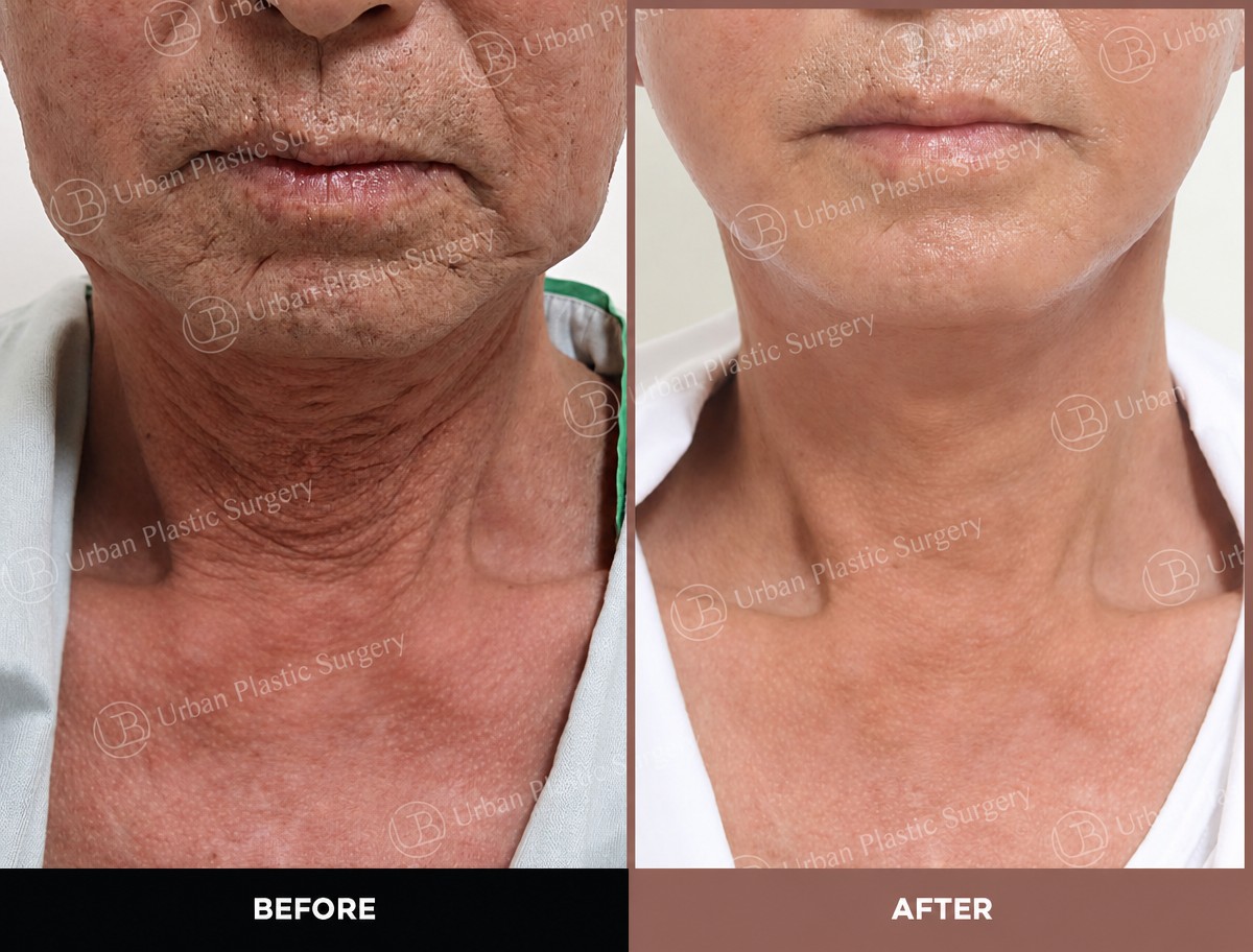 نتائج شد الرقبة قبل وبعد في URBAN Plastic Surgery – تحسن واضح في شد الجلد