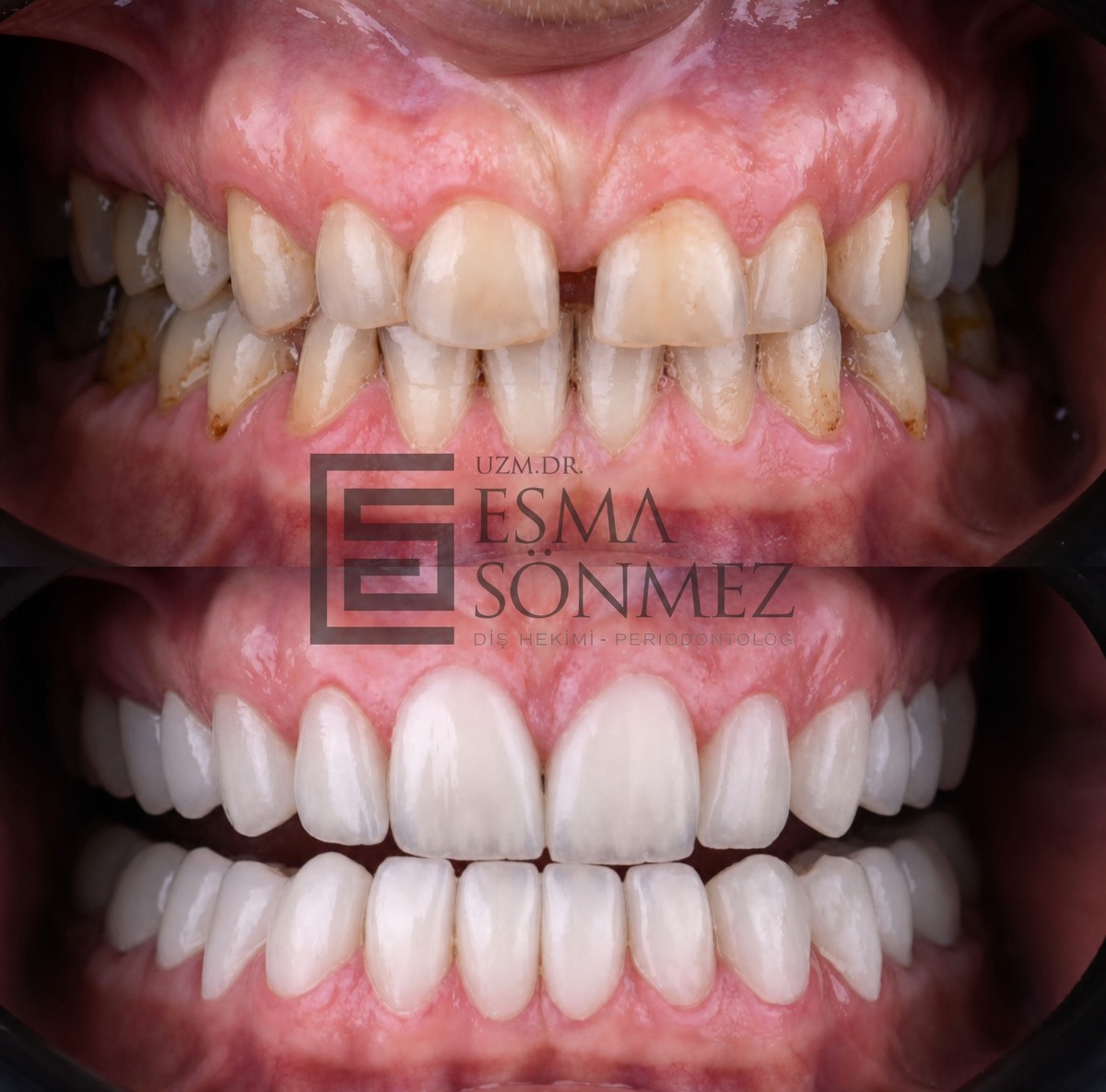 نتائج قبل وبعد تقويم Invisalign في مستشفى Memorial Bahçelievler، تحسين ترتيب الأسنان