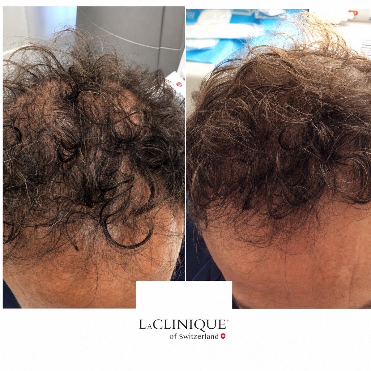 نتائج الميزوثيرابي للشعر قبل وبعد في LaCLINIQUE of Switzerland، كثافة شعر محسنة