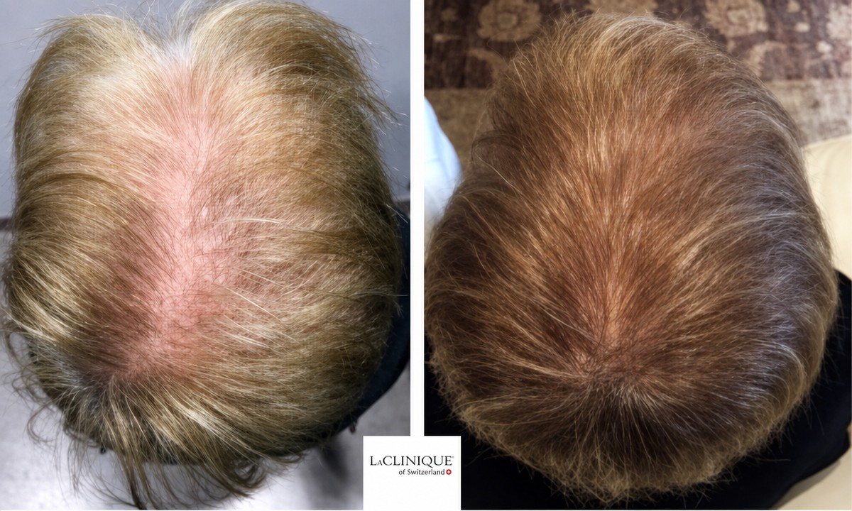 Resultados de mesoterapia capilar antes y después en LaCLINIQUE of Switzerland, mayor densidad