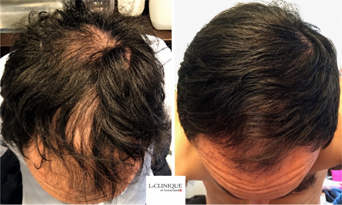 Before and after hair mesotherapy results at LaCLINIQUE of Switzerland, improved hair density