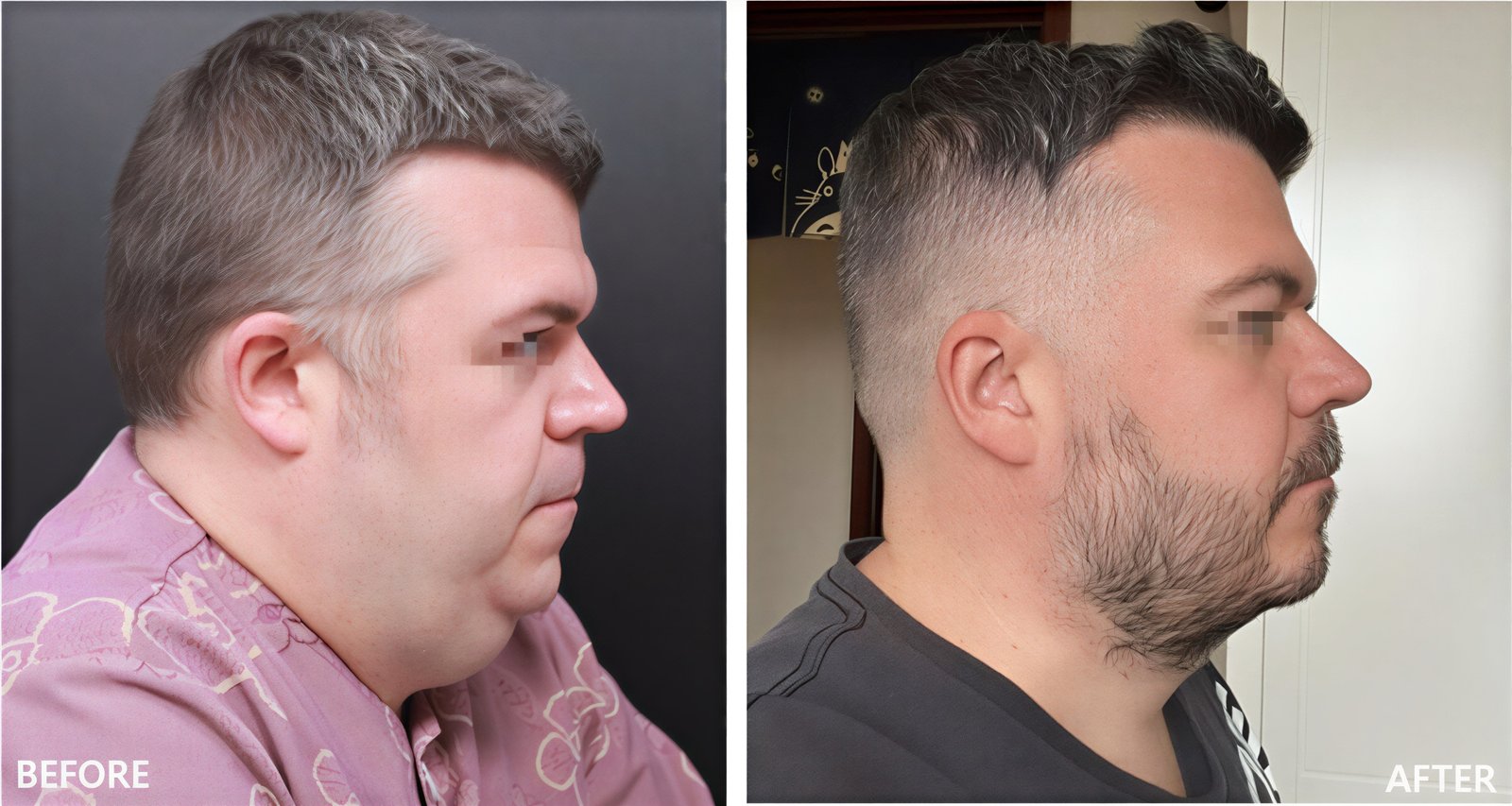 نتائج شفط دهون الذقن قبل وبعد في VG Plastic Surgery – تحديد الفك بشكل أفضل