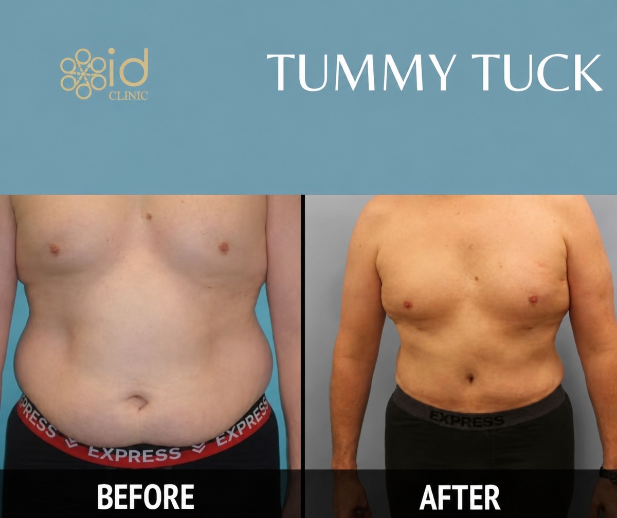 Before and after tummy tuck results at ID Clinic Bangkok showing improved abdominal contour