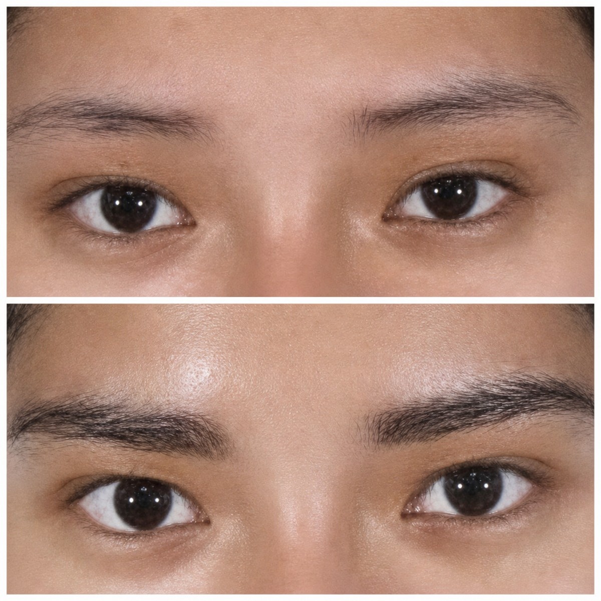 Before and after eyebrow transplantation results at ID Clinic Bangkok, fuller natural brows