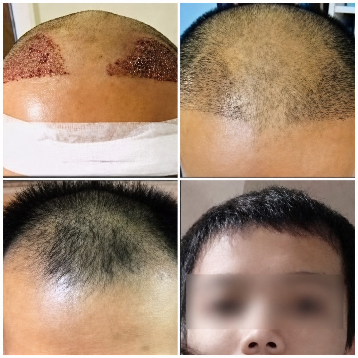 نتائج زراعة الشعر بتقنية FUE قبل وبعد في Asia Cosmetic Hospital، نمو شعر ملحوظ