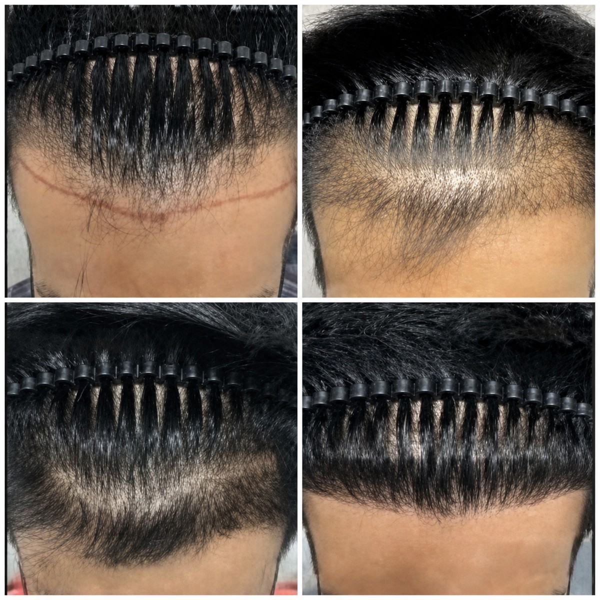 نتائج زراعة الشعر FUE قبل وبعد في Asia Cosmetic Hospital، كثافة خط الشعر