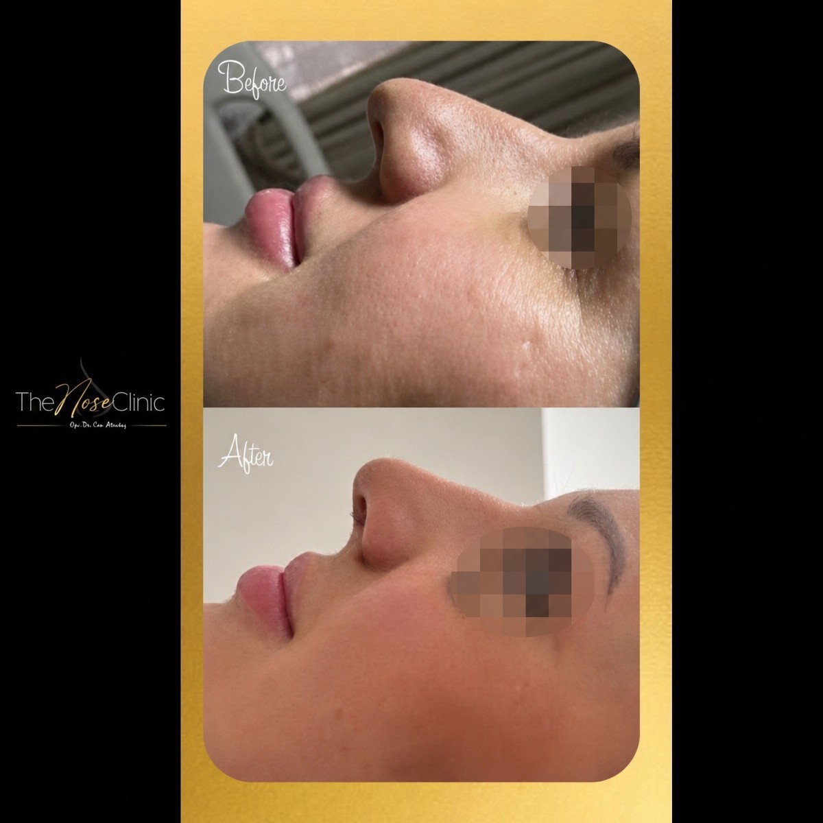 Результаты до и после риносептопластики в The Nose Clinic, улучшенный профиль носа