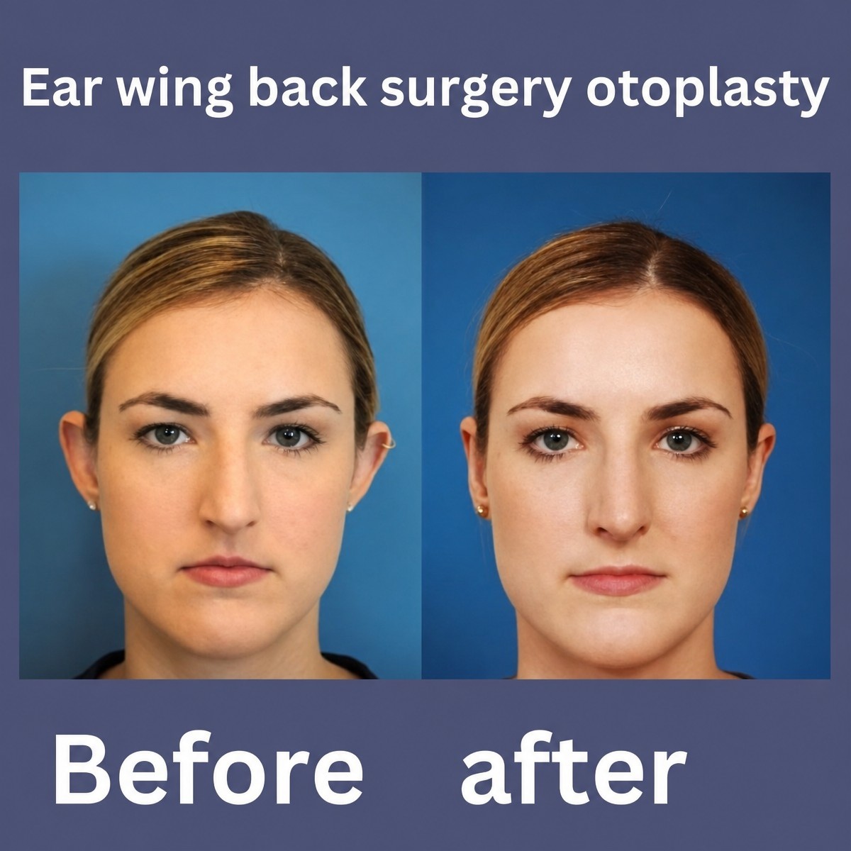 Before and after otoplasty results at ID Clinic Bangkok – ear reshaping surgery outcome