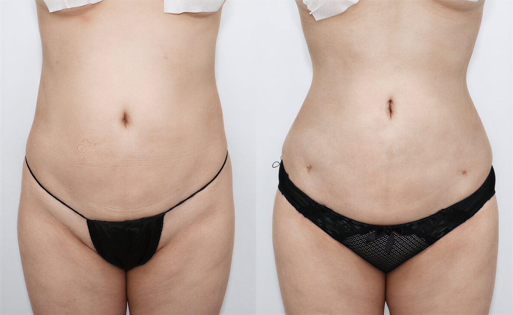Resultados de liposucción abdominal antes y después en Bbae Clinic, mejora visible de la cintura