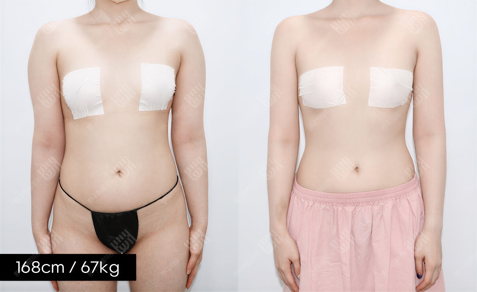 Resultados de liposucción de brazos antes y después en Bbae Clinic, mejora del contorno