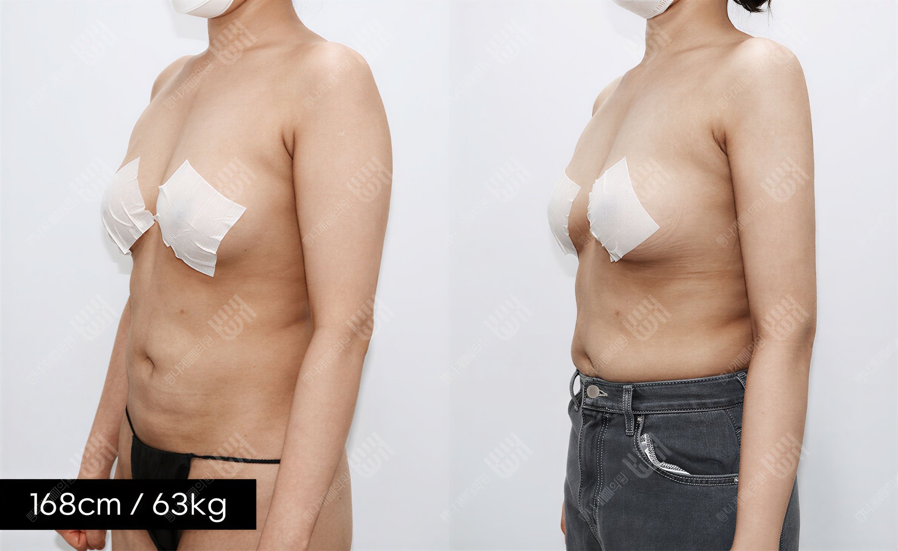 Resultados de liposucción de brazos antes y después en Bbae Clinic, contorno mejorado