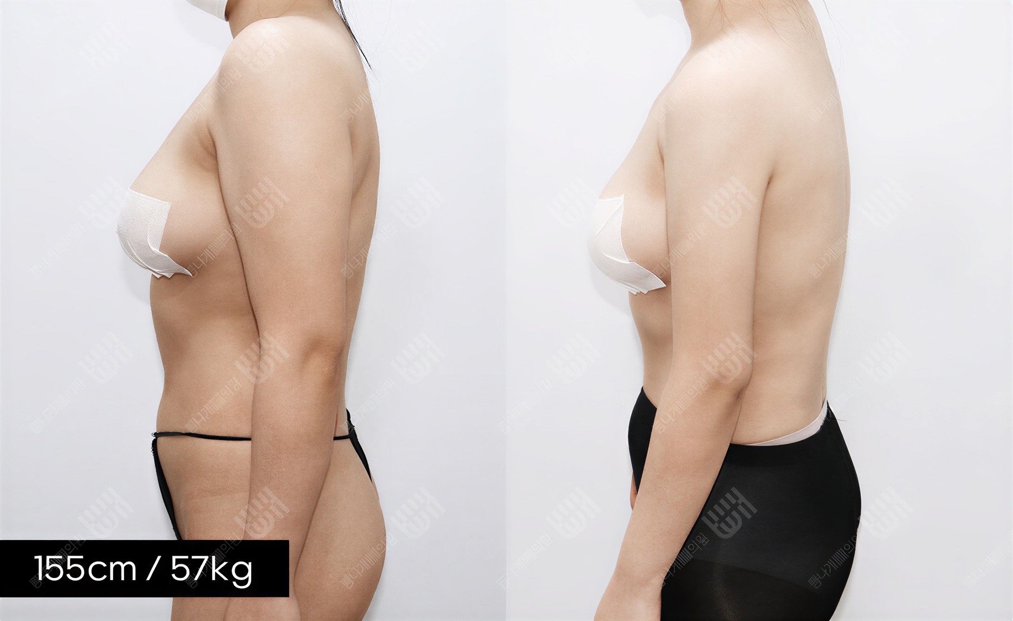 Resultados de liposucción de brazos en Bbae Clinic, mejora visible del contorno del brazo