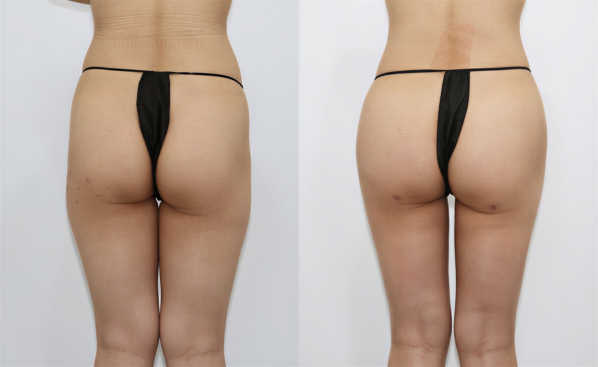 Resultados antes y después de Brazilian Butt Lift en Bbae Clinic, glúteos mejorados