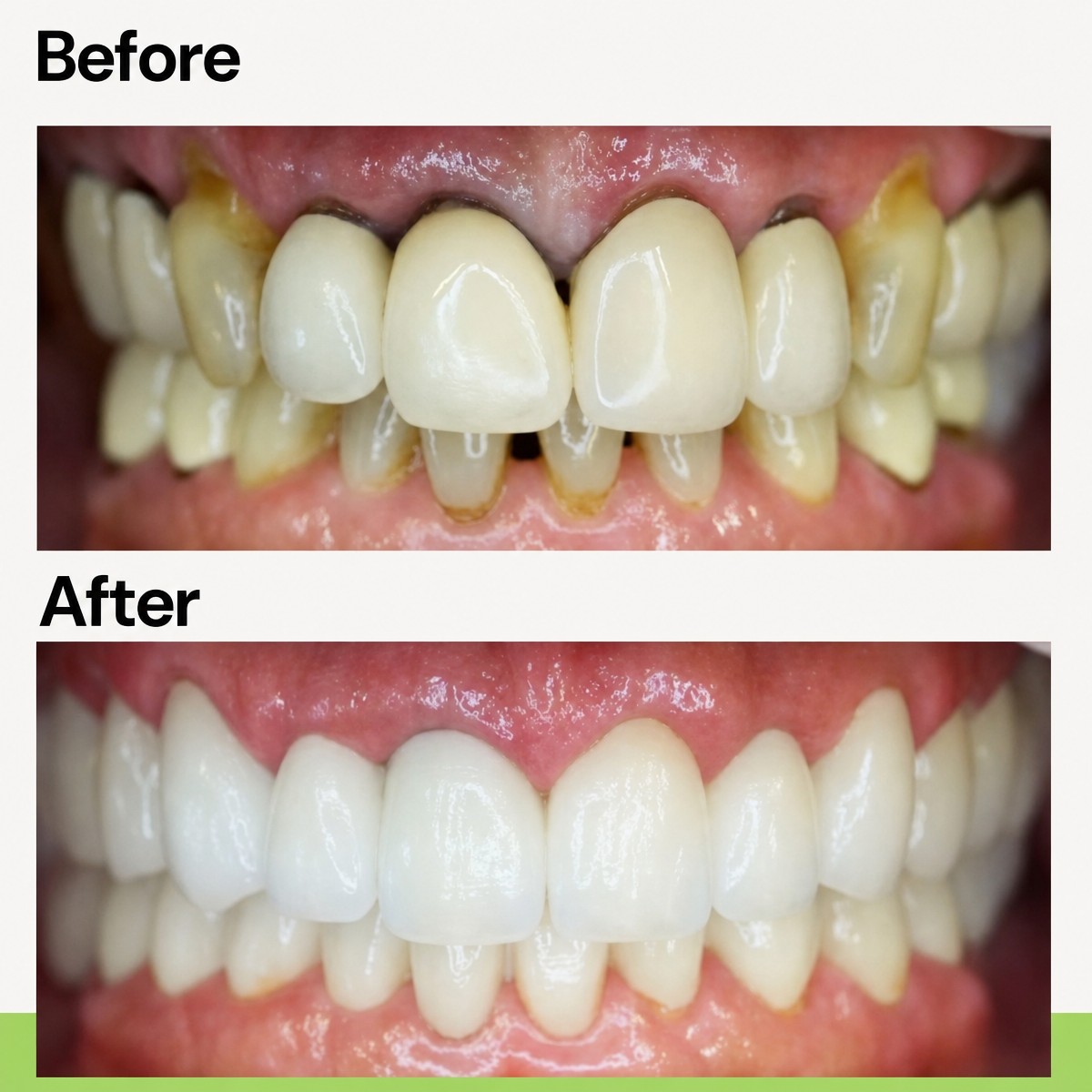 Результаты до и после имплантации зубов в Evergreen Dental – улучшение улыбки и прикуса