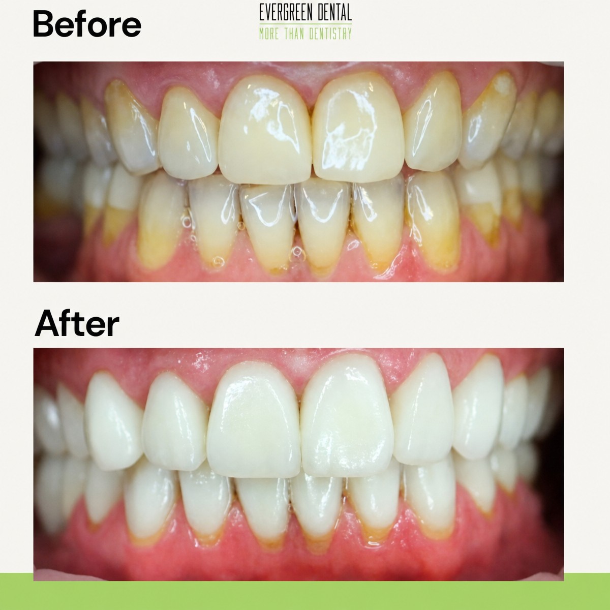 Before and after dental implant results at Evergreen Dental – improved smile and whiter teeth
