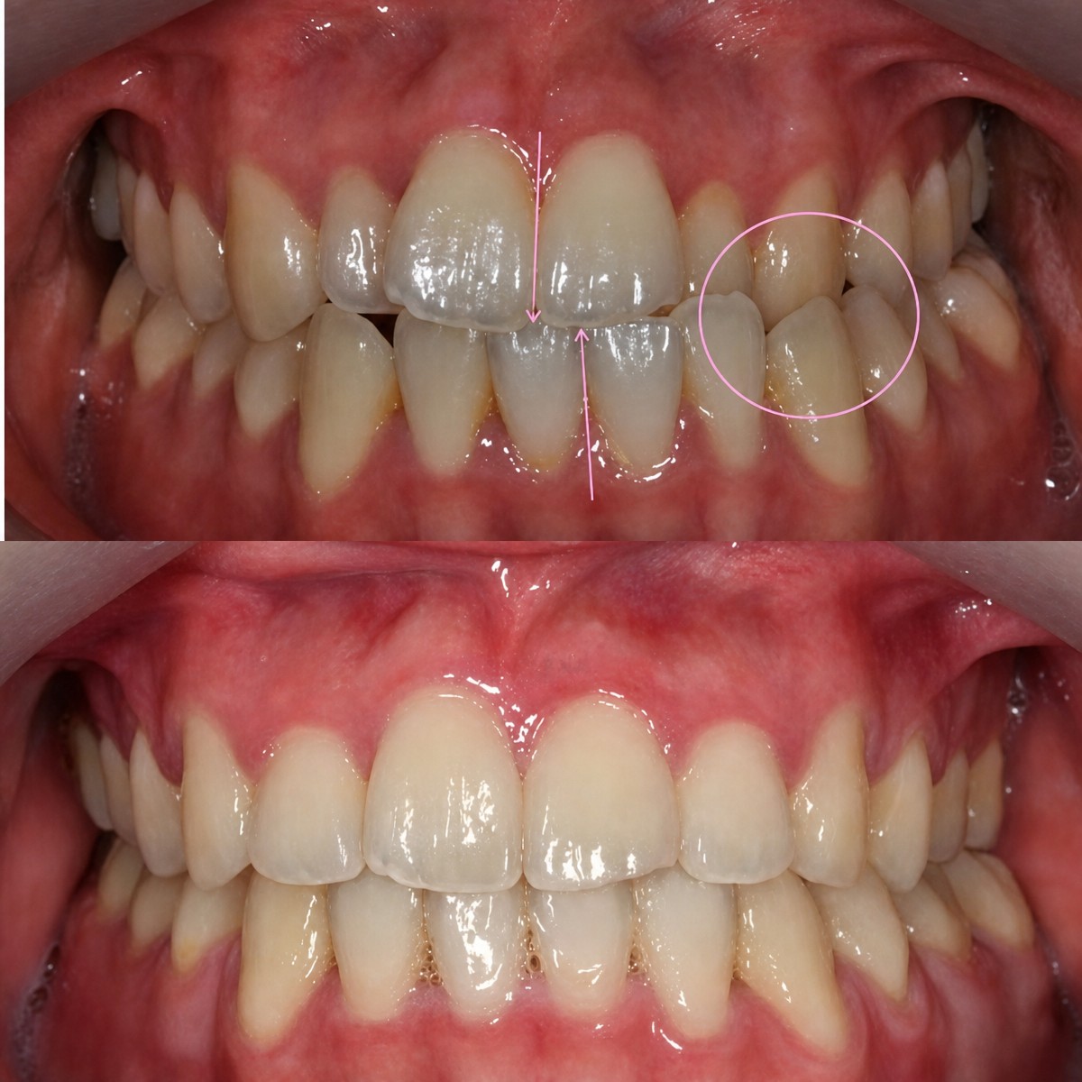 Before and after braces results at Yonsei JW Dental Clinic, improved teeth alignment visible
