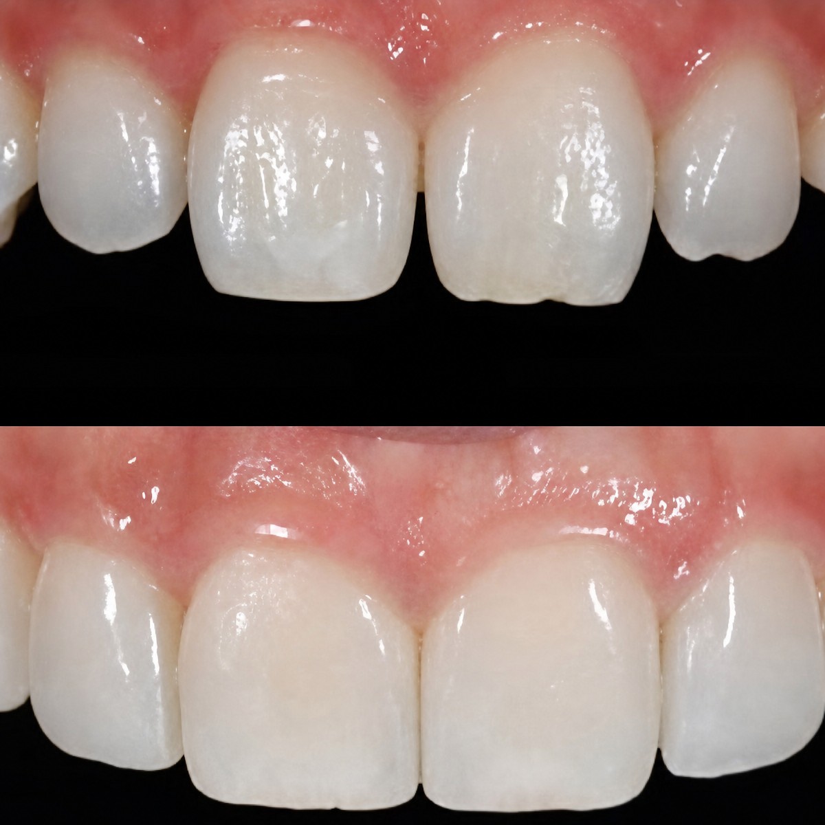 Before and after no prep veneers result at Yonsei JW Dental Clinic, improved smile aesthetics