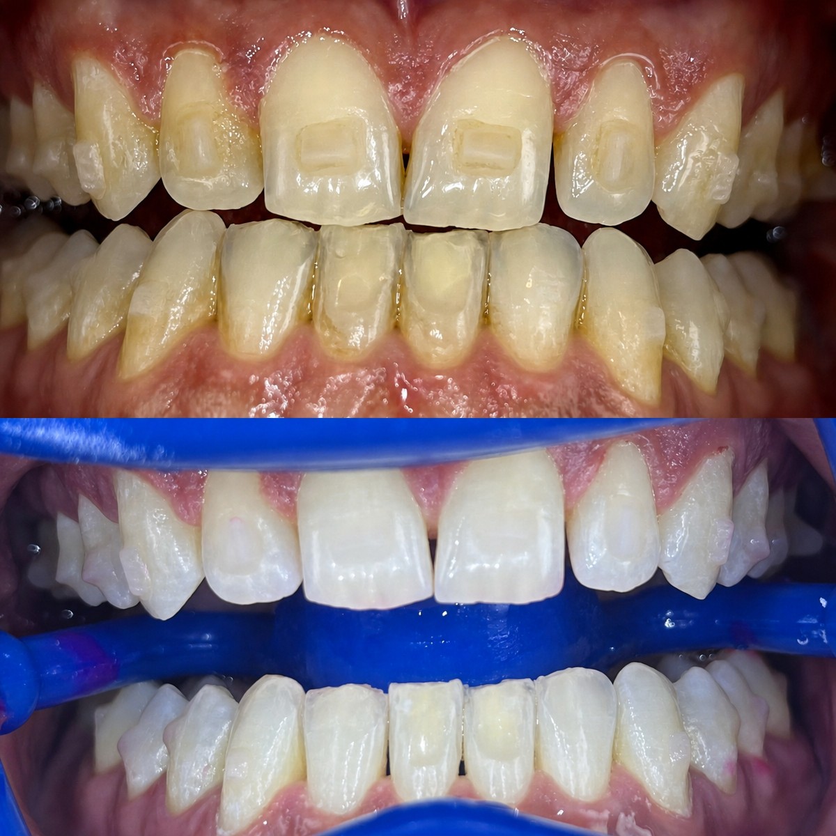 Результаты до и после отбеливания зубов в Smile Centrum, заметно более белые зубы