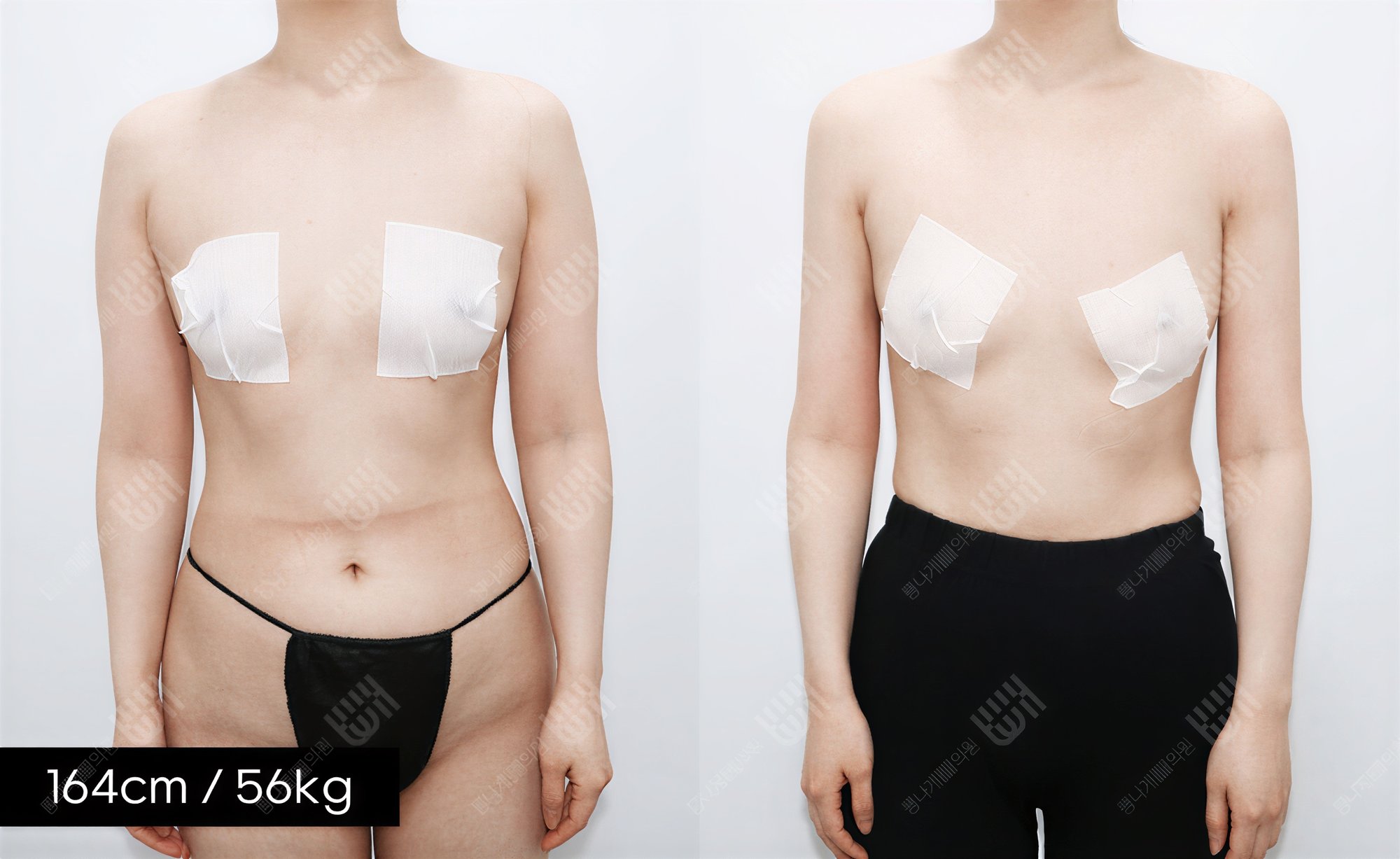 Resultados de liposucción antes y después en Bbae Clinic, mejora visible del contorno corporal