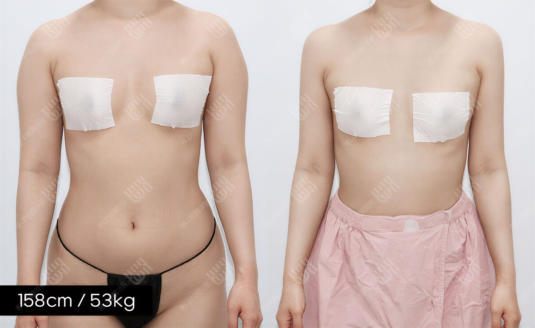 Resultados de liposucción antes y después en Bbae Clinic, mejora visible del contorno corporal