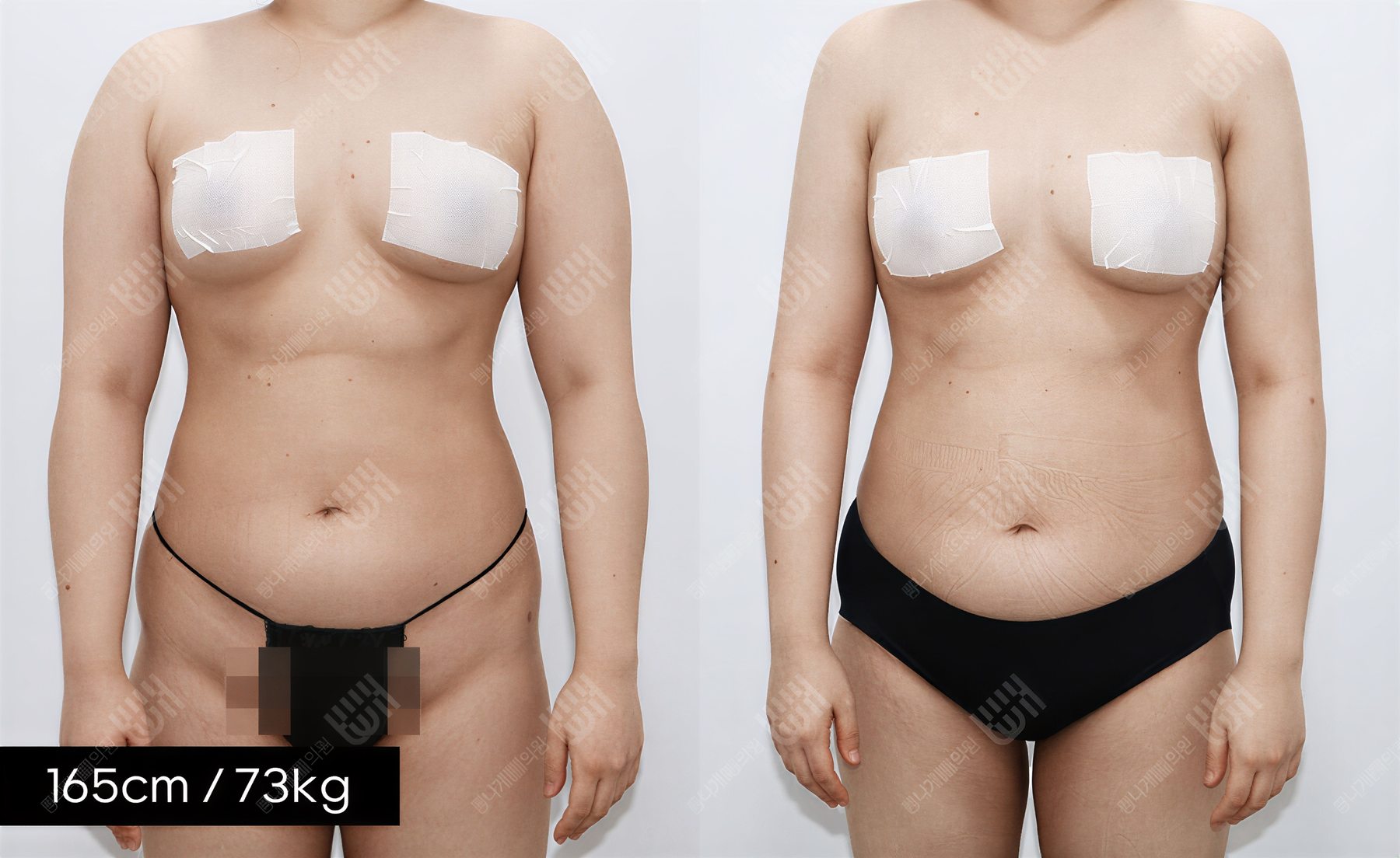 Resultados de liposucción antes y después en Bbae Clinic, mejora visible del contorno corporal