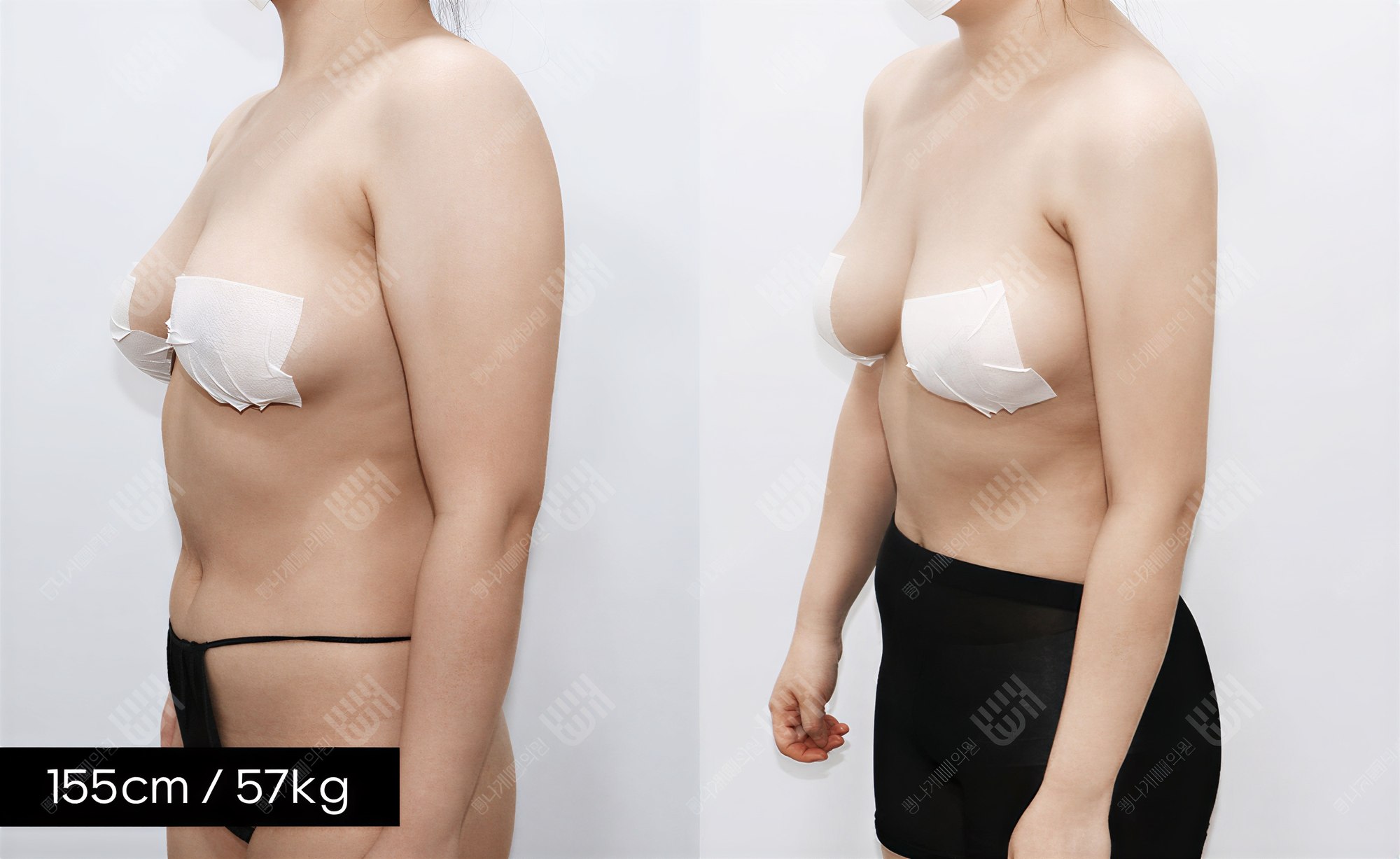 Resultados de liposucción antes y después en Bbae Clinic, mejora visible del contorno corporal