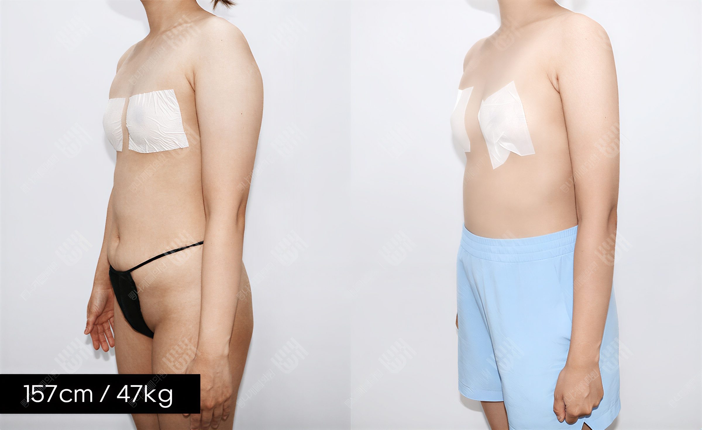 Resultados de liposucción antes y después en Bbae Clinic, mejora visible del contorno corporal