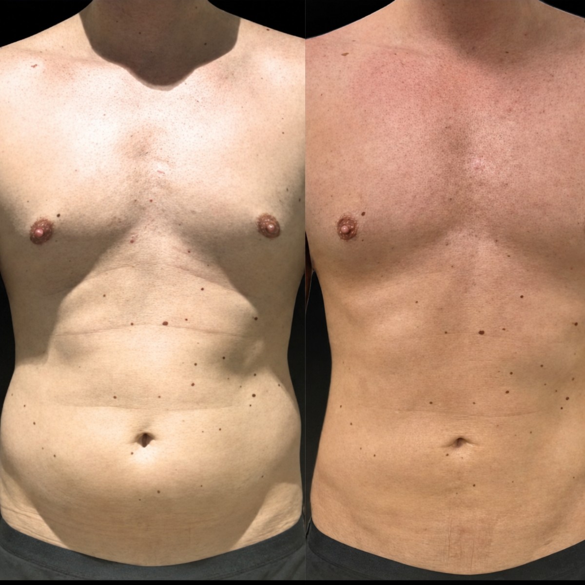 Before and after liposuction results at Memorial Bahçelievler Hospital, improved abdominal contour