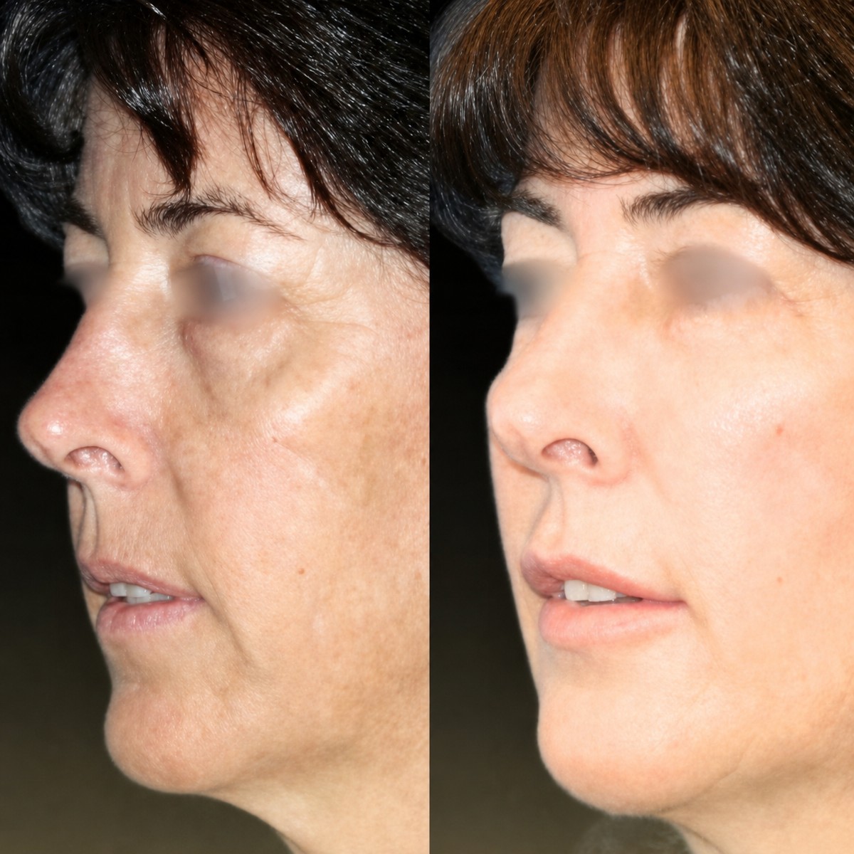 Avant et après lipofilling du visage à Memorial Bahçelievler Hospital, résultat rajeunissant