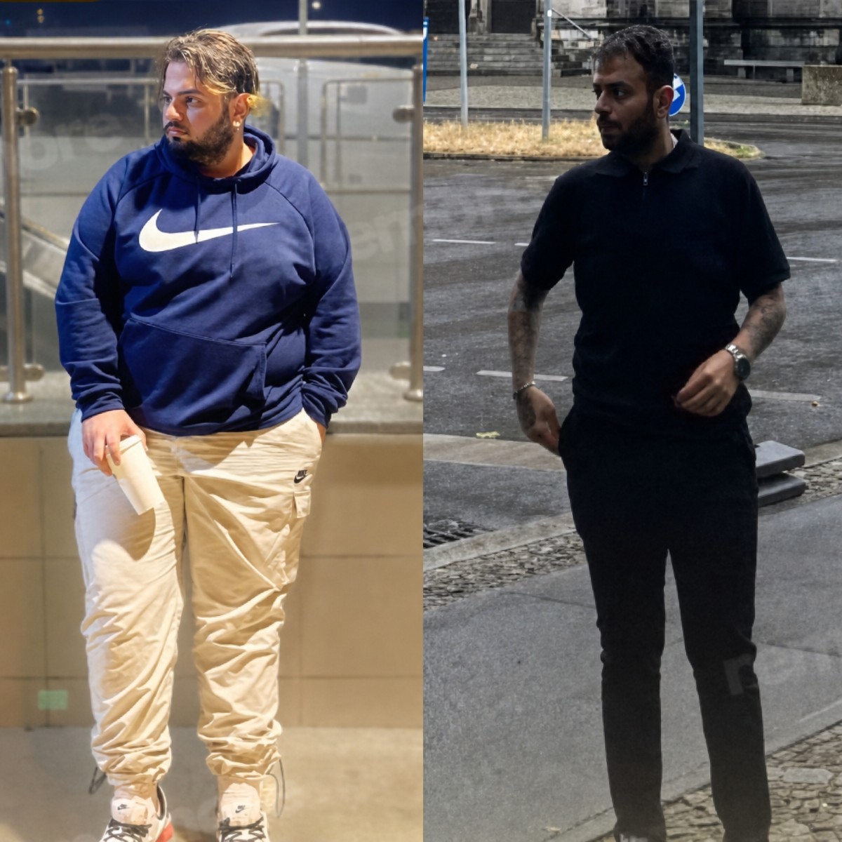 Before and after Roux-en-Y gastric bypass at Memorial Şişli Hospital, visible weight loss result