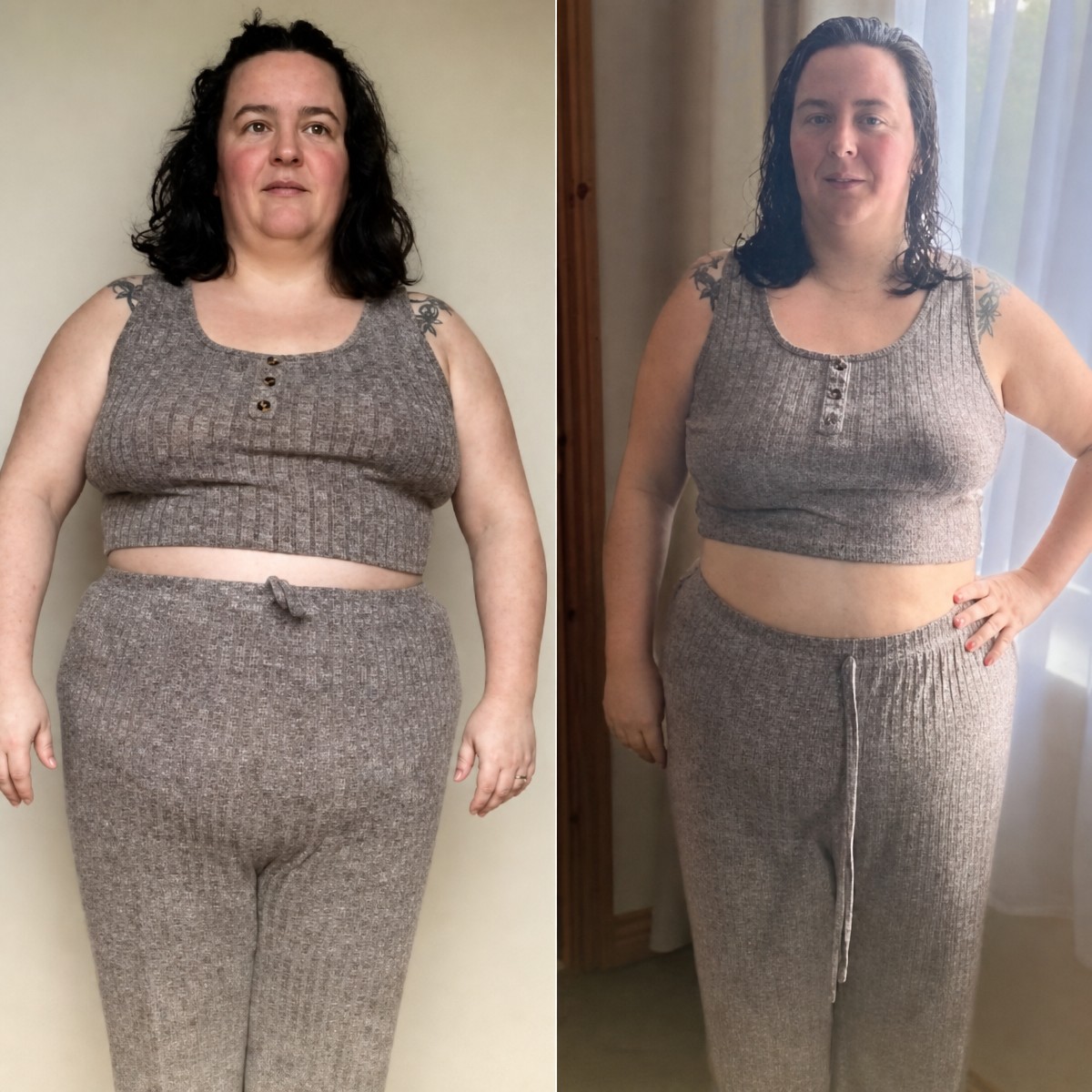 Before and after endoscopic sleeve gastroplasty at Memorial Şişli Hospital, weight loss result