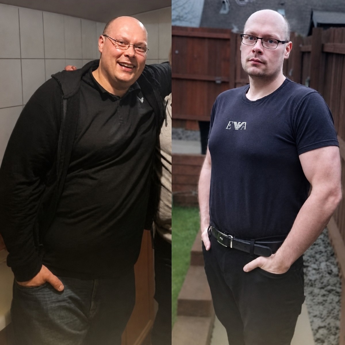 Before and after gastric balloon results at Memorial Şişli Hospital, visible weight loss transformation