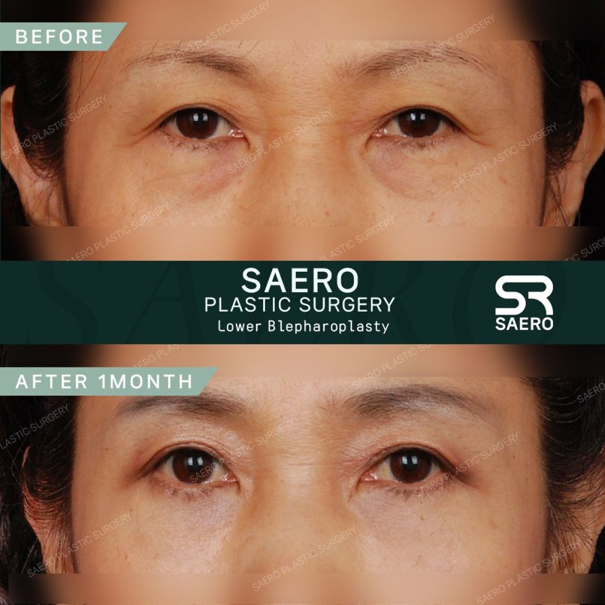 نتائج رأب الجفن السفلي قبل وبعد في عيادة SAERO Plastic Surgery