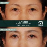 Fotos vor und nach Blepharoplastik (Augenlidkorrektur) durch Dr. Park Young Kyu