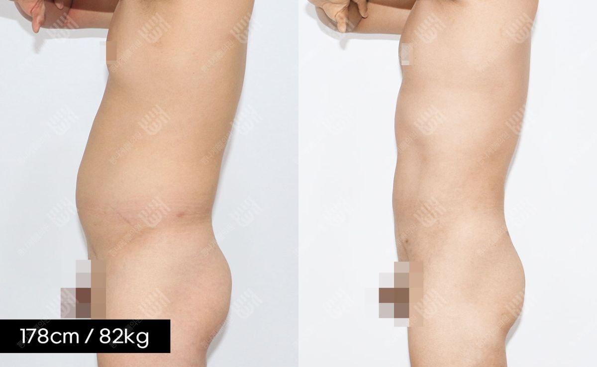 Before and after abdominal liposuction results at Bbae Clinic, visible body contour improvement