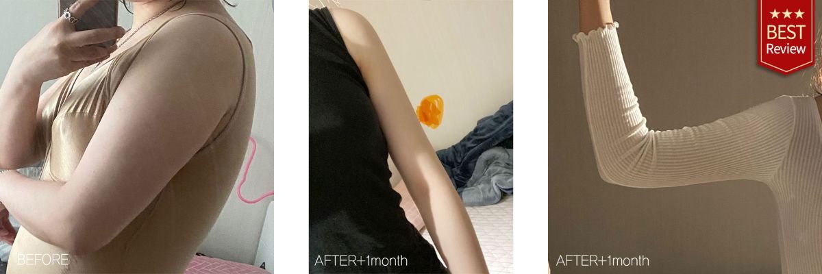 Before and after upper arm liposuction results at Bbae Clinic – slimmer arm contour visible