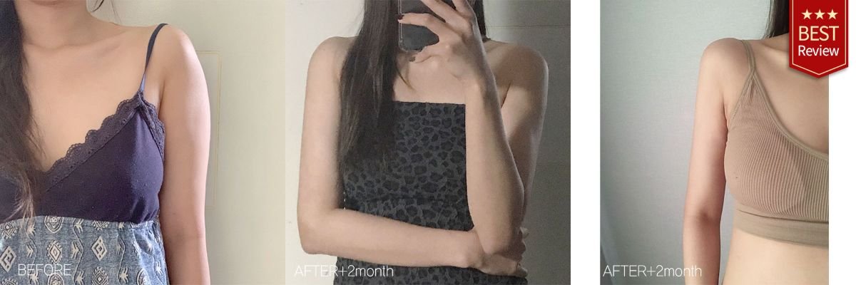 Upper arm liposuction before and after results at Bbae Clinic – slimmer arm contour visible
