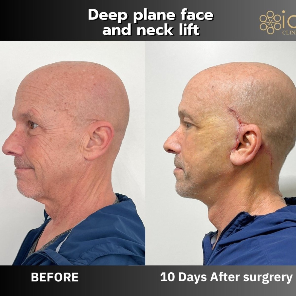 Résultats avant/après lifting profond visage et cou à ID Clinic Bangkok, effet lift visible
