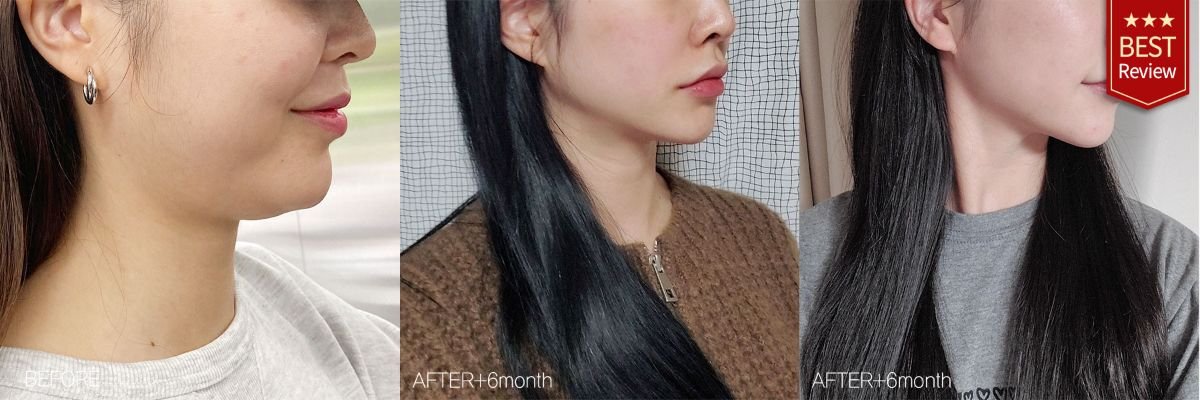 Before and after face liposuction results at Bbae Clinic – improved jawline contour