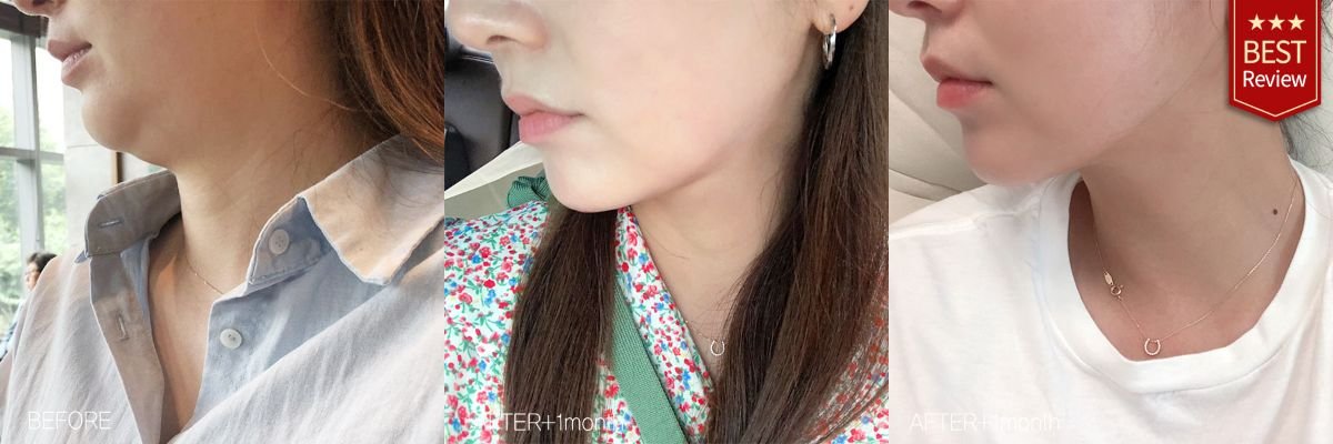 Face liposuction before and after results at Bbae Clinic – improved jawline contour