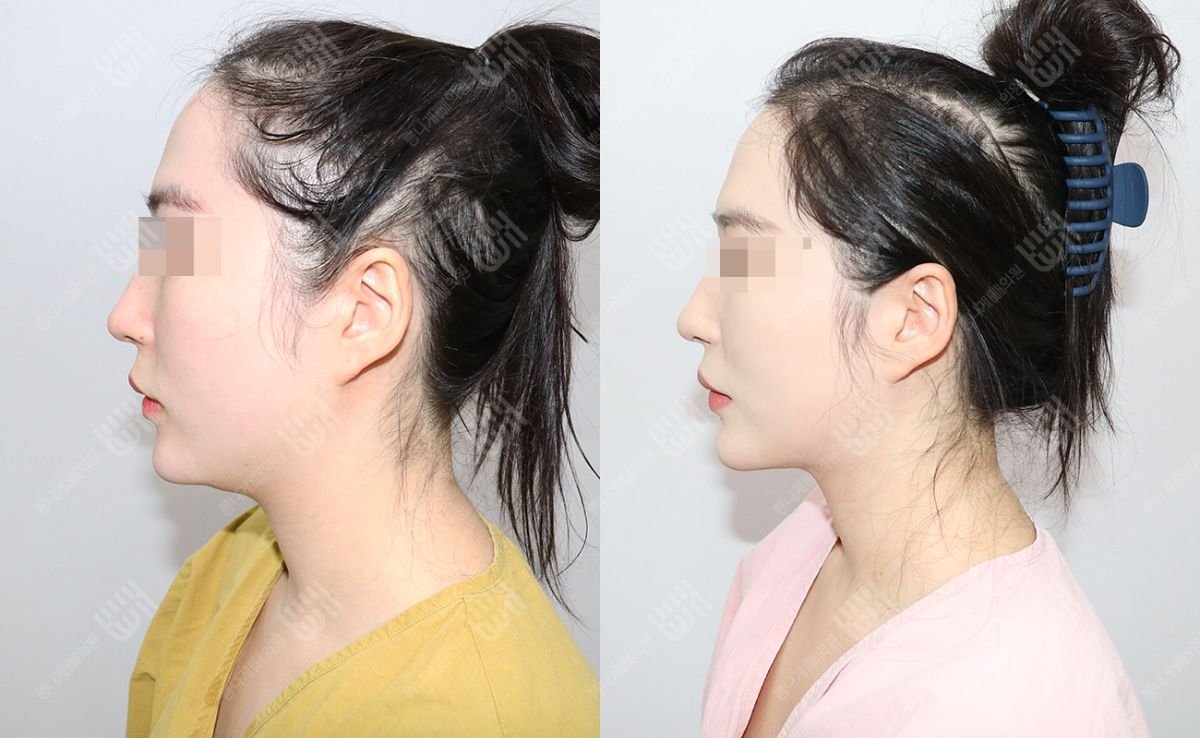 Before and after face liposuction results at Bbae Clinic, improved jawline contour visible