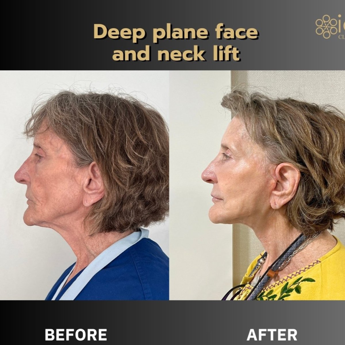 Before and after deep plane facelift and neck lift results at ID Clinic Bangkok
