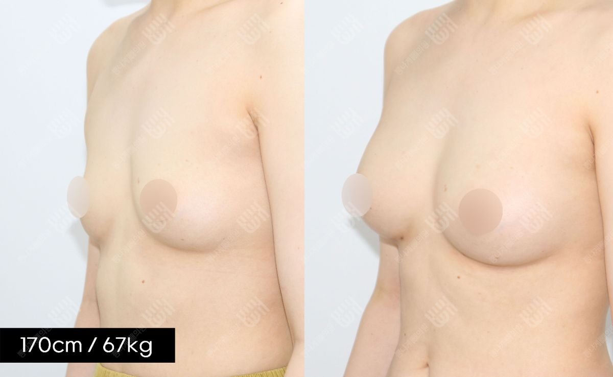 Результат до и после увеличения груди липофилингом в Bbae Clinic, естественный вид